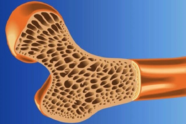 پوکی استخوان در نیمی از جمعیت کشور/ فوت یک‌پنجم افراد دچار شکستگی لگن